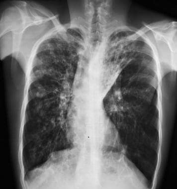 Cystic fibrosis, thoracic. Patient with history of