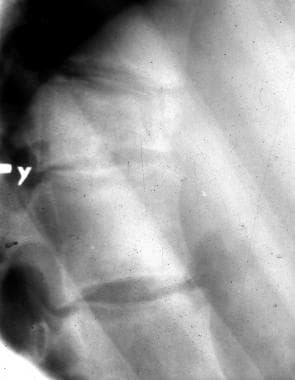 Lateral radiograph of the dorsal spine shows a wed