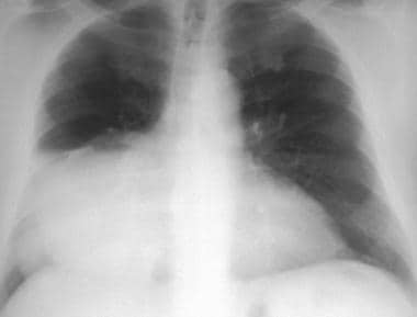 Posteroanterior chest radiograph shows a large mas