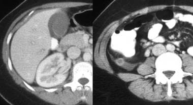 Atypical presentation of appendicitis in a young w