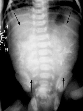 Autosomal recessive polycystic kidney disease (ARP