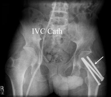 Anteroposterior pelvic radiograph of a renal trans