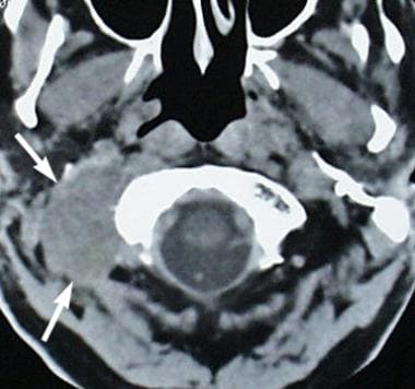 Metastatic prostate cancer (arrows) involves the s