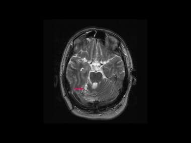 von Hippel-Lindau syndrome. Axial T2-weighted MRI 