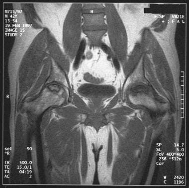 Coronal T1-weighted MRI in a 42-year-old man with 