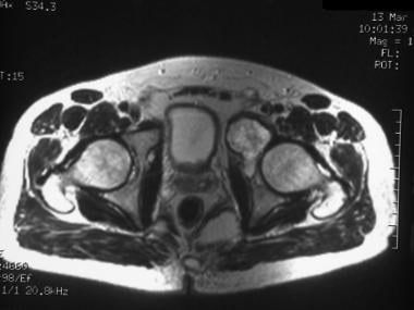 T2-weighted axial MRI of the pelvis demonstrates t