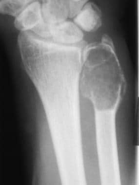 Anteroposterior radiograph of the left wrist shows
