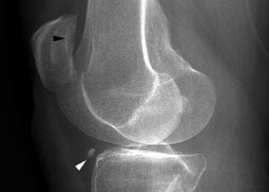 Lateral radiograph of the knee reveals a calcified