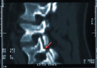 Sagittally reconstructed CT of the lumbar spine sh