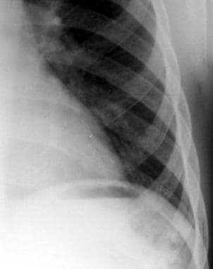 Thalassemia. Radiograph of the ribs. Note the long