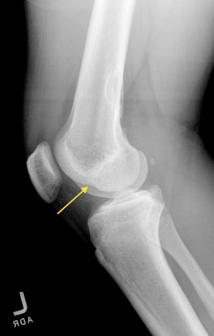 Deep lateral femoral notch (sulcus) sign as a seco