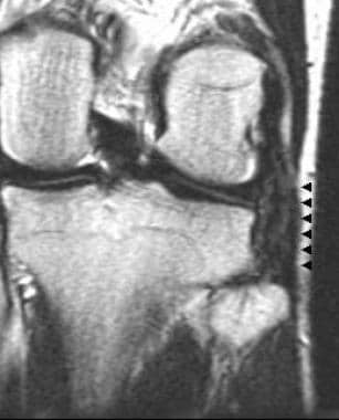 Chronic lateral collateral ligament tear appearing