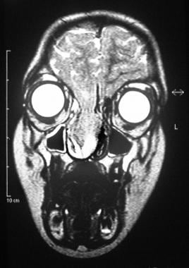 Coronal, T2-weighted magnetic resonance imaging (M