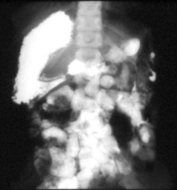 Polysplenia. Upper gastrointestinal (UGI) radiogra