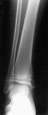 Salter-Harris type IV fracture of the distal tibia