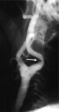Lateral common carotid arteriogram in a patient wi