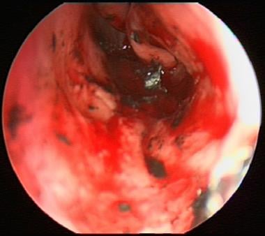 View of the nasal cavity after removal of the fore