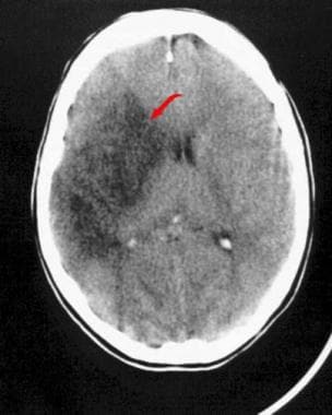 MCA stroke - Emergency neuroradiology. Axial CT sc