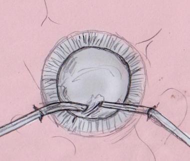 Cataract surgery illustration of cortex and capsul
