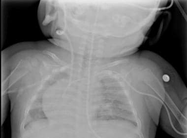 Shunt series, Radiology Reference Article