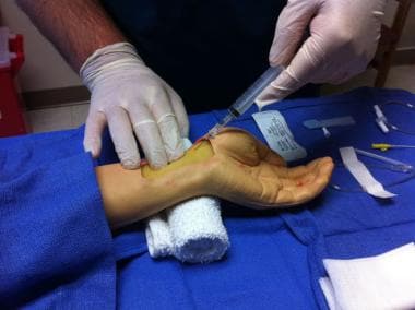 Radial artery cannulation (Seldinger). Puncture of