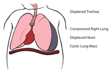 Diagram of cystic lung mass compressing the lung a