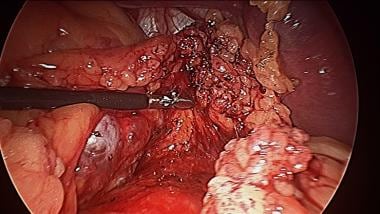 Continued posterior dissection in a cephalad direc
