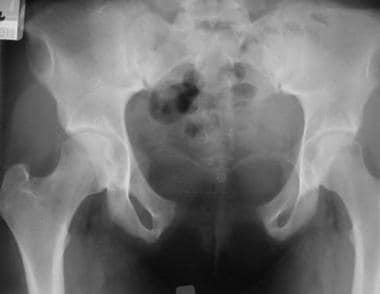 Typical appearance of pelvis in patient with exstr