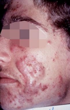 Acne Vulgaris Clinical Presentation History Physical Examination