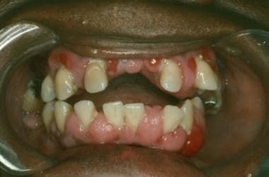 Hyperplasia gingival Gingival enlargement