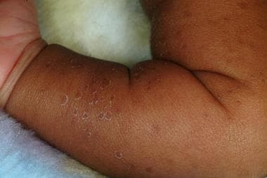 Image result for transient neonatal pustular melanosis