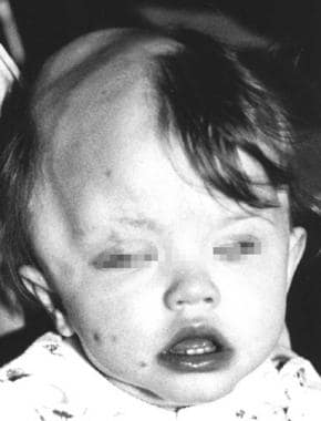 A child with Haberland syndrome. Apparent alopecia