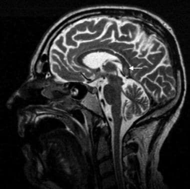 T2-weighted axial image in a patient with Marchiaf