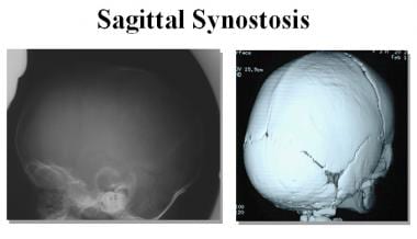 Sagittal synostosis and the associated scaphocepha