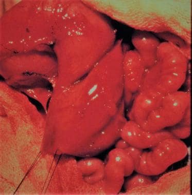 Intestinal obstruction in the newborn. Anastomosis