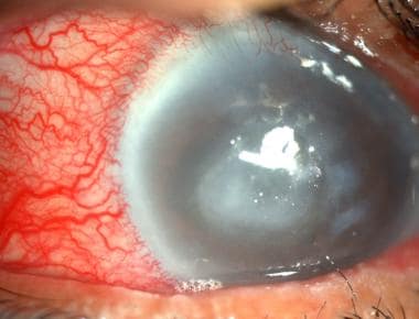 fungal corneal ulcer satellite lesion