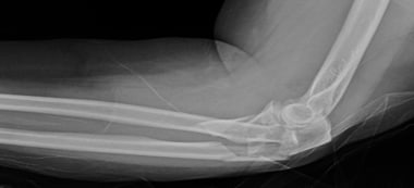 Monteggia-variant fracture of proximal ulna and ra