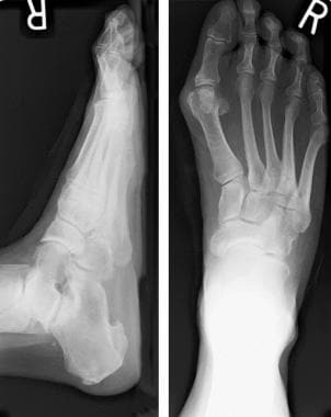 Anteroposterior and lateral radiographs, weightbea