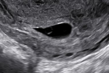Pregnancy diagnosis. A gestational sac with a yolk
