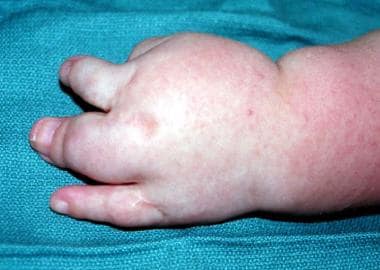 Left hand of patient with type II Apert syndrome. 