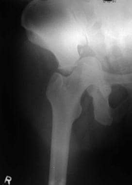 T-shaped fracture, obturator view. 