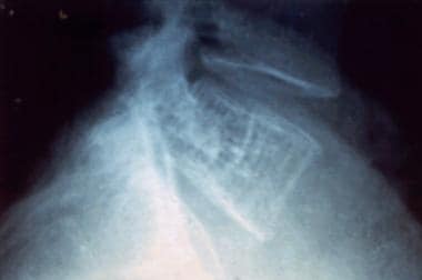 Radiograph of a vertebral hemangioma illustrating 