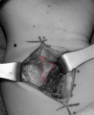 Intraoperative photo of Vickers ligament, outlined