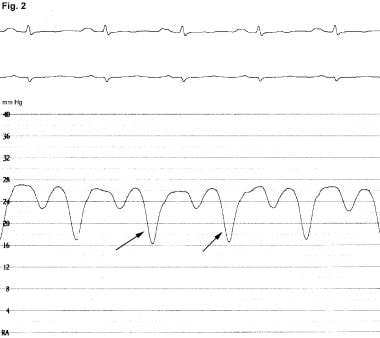 Constrictive Pericarditis. This right atrial press