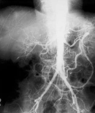 Angiogram of patient with chronic mesenteric ische