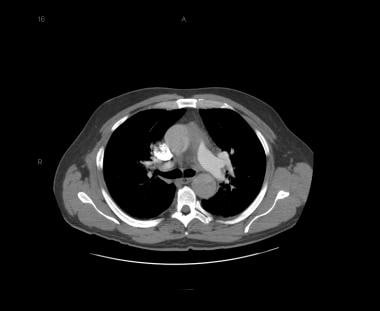 Patient with a type A aortic dissection involving 