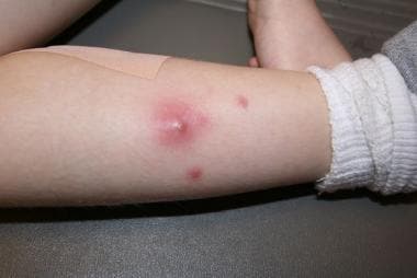 Abscess and associated cellulitis caused by commun