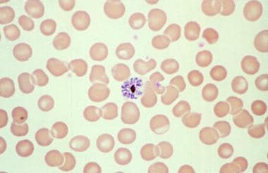 An erythrocyte filled with merozoites, which soon 