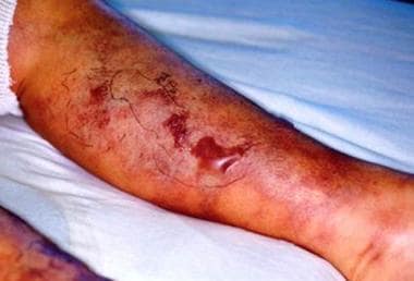 Chronic kidney disease: Calciphylaxis due to secon