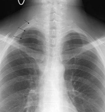 Chest PA radiograph showing a right cervical rib (